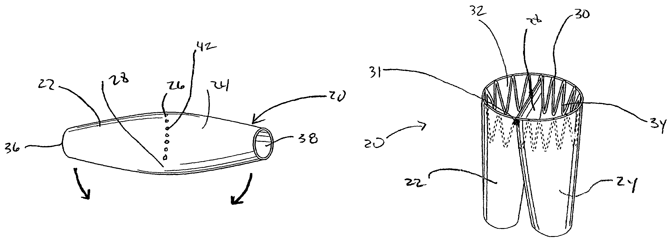 Endoluminal graft