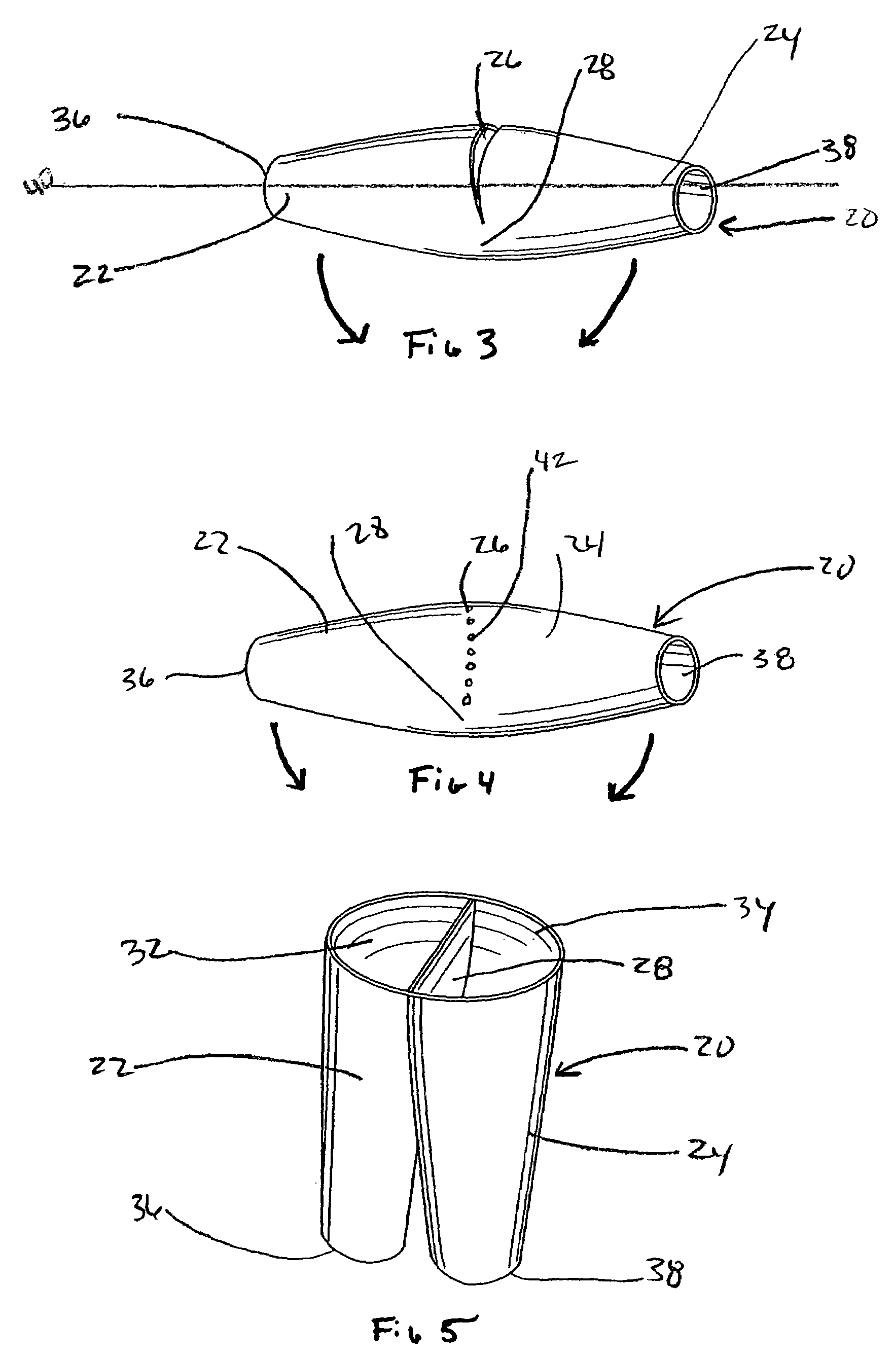 Endoluminal graft