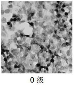 Grading model for detecting benign/malignant degrees of lymphoma and lymphatic metastatic cancer and application of grading model