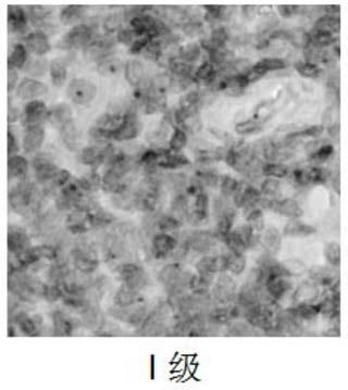 Grading model for detecting benign/malignant degrees of lymphoma and lymphatic metastatic cancer and application of grading model