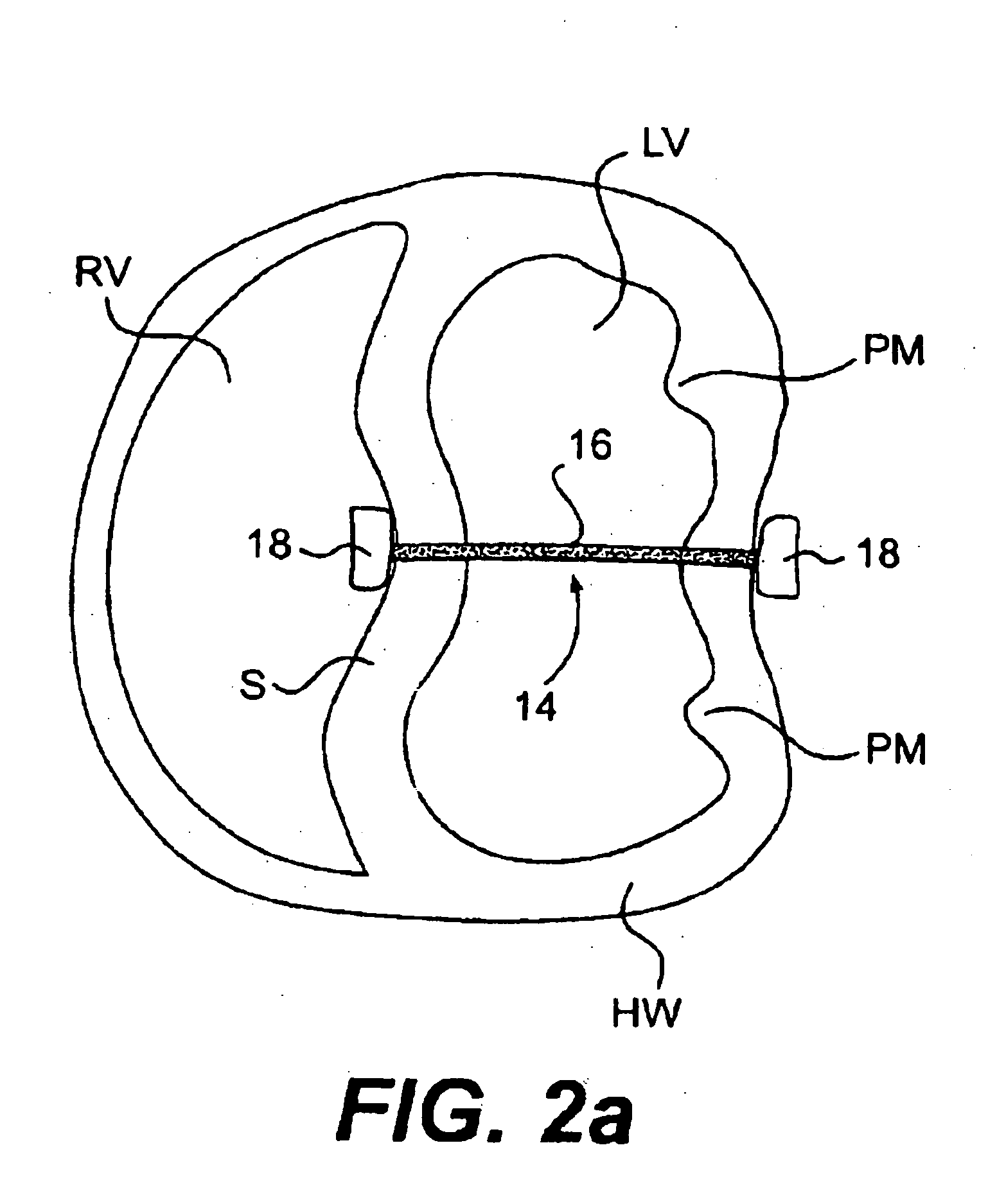 Methods and devices for improving mitral valve function