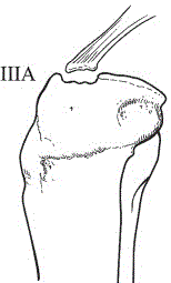 Net bag device for treating ACL tibial avulsion fracture