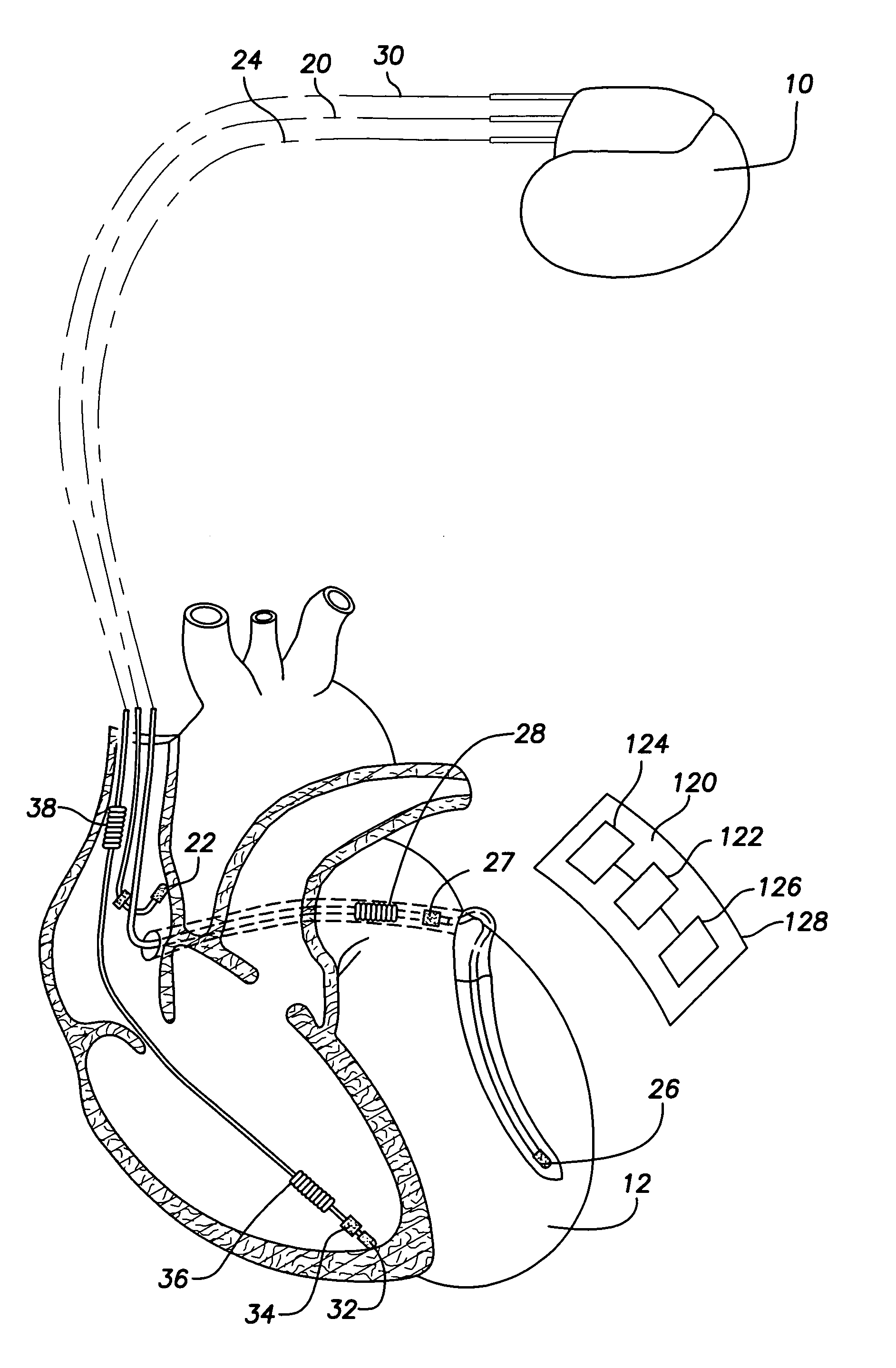 Subcutaneous cardiac stimulation device providing anti-tachycardia pacing therapy and method