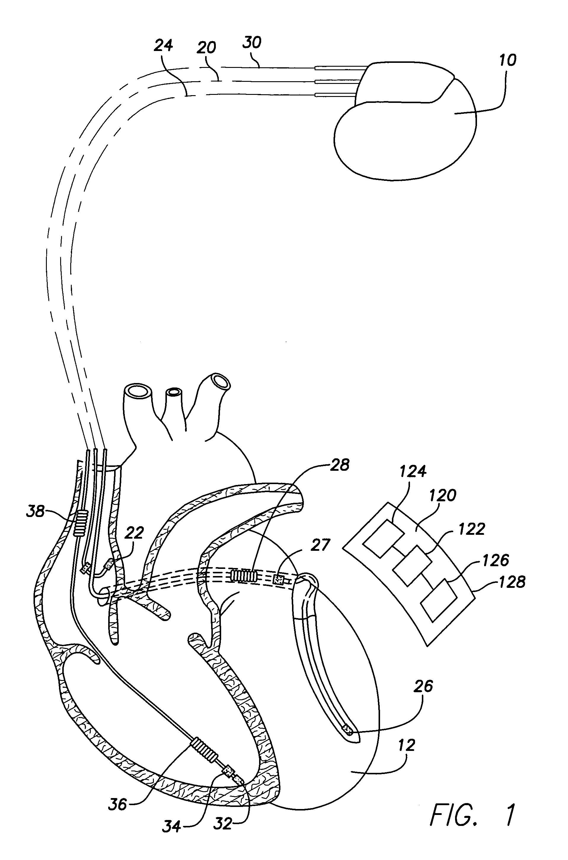 Subcutaneous cardiac stimulation device providing anti-tachycardia pacing therapy and method