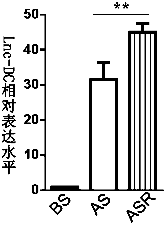 Application of non-coding RNA molecule Lnc-DC in predicting drug resistance of tamoxifen in breast cancer