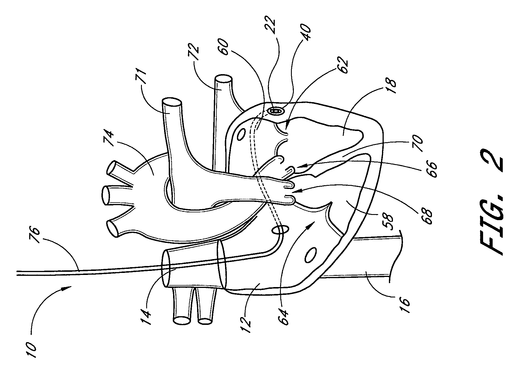 Remotely adjustable coronary sinus implant