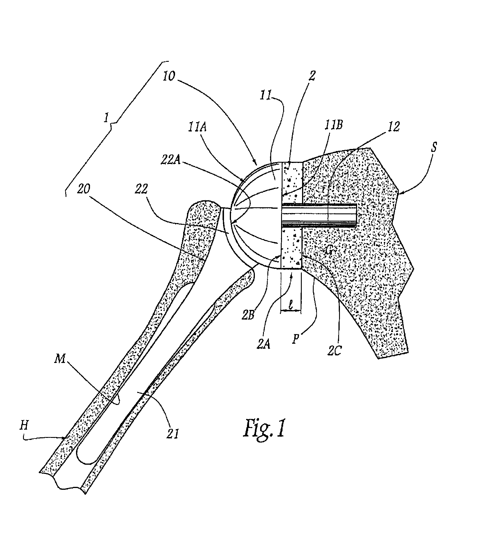 Method and apparatus for fitting a shoulder prosthesis