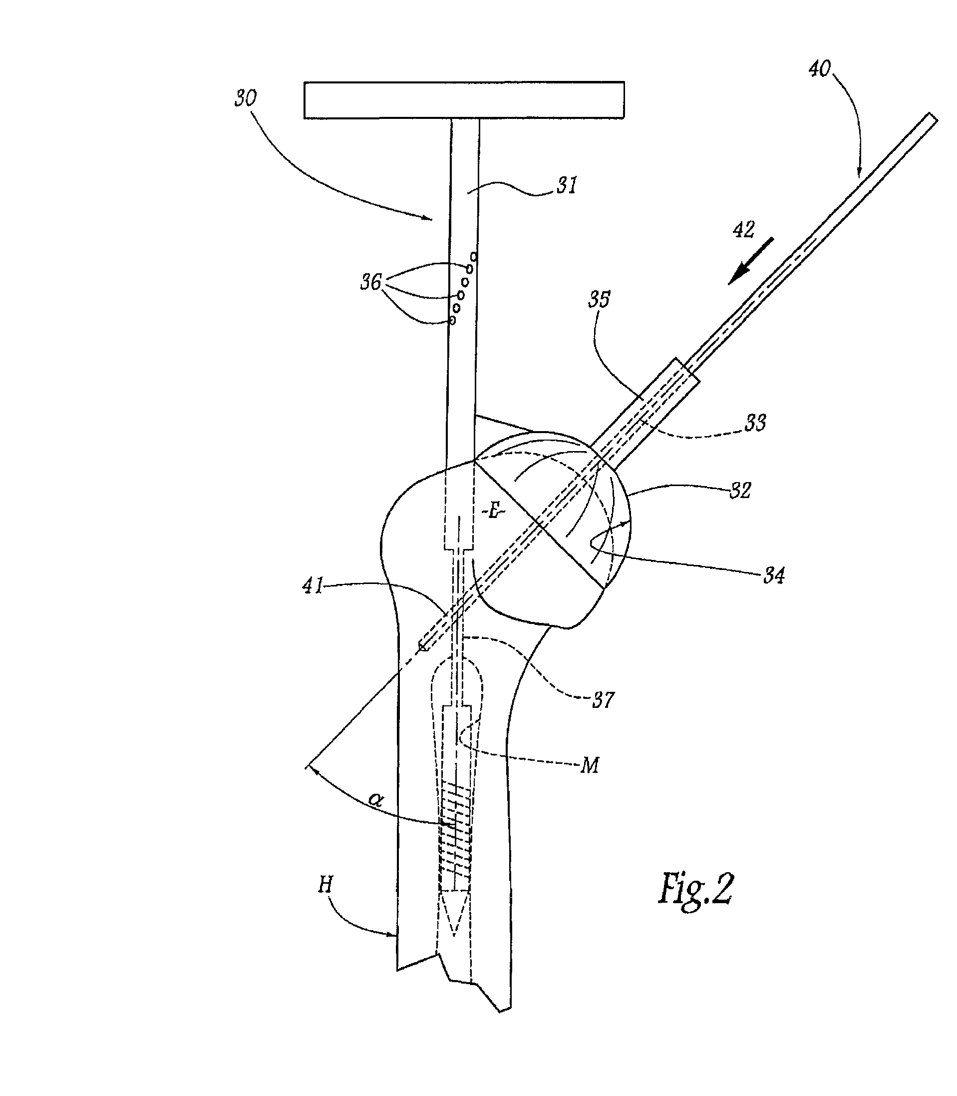 Method and apparatus for fitting a shoulder prosthesis