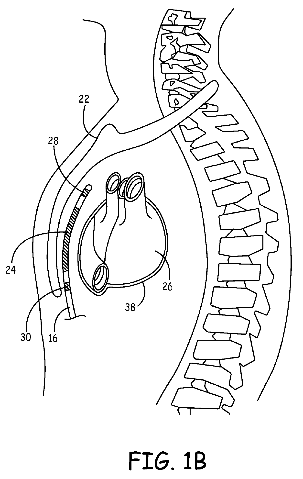 Implantable cardioverter-defibrillator (ICD) system including substernal lead