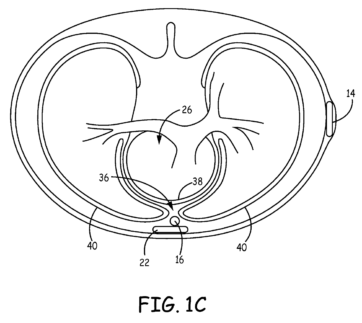 Implantable cardioverter-defibrillator (ICD) system including substernal lead