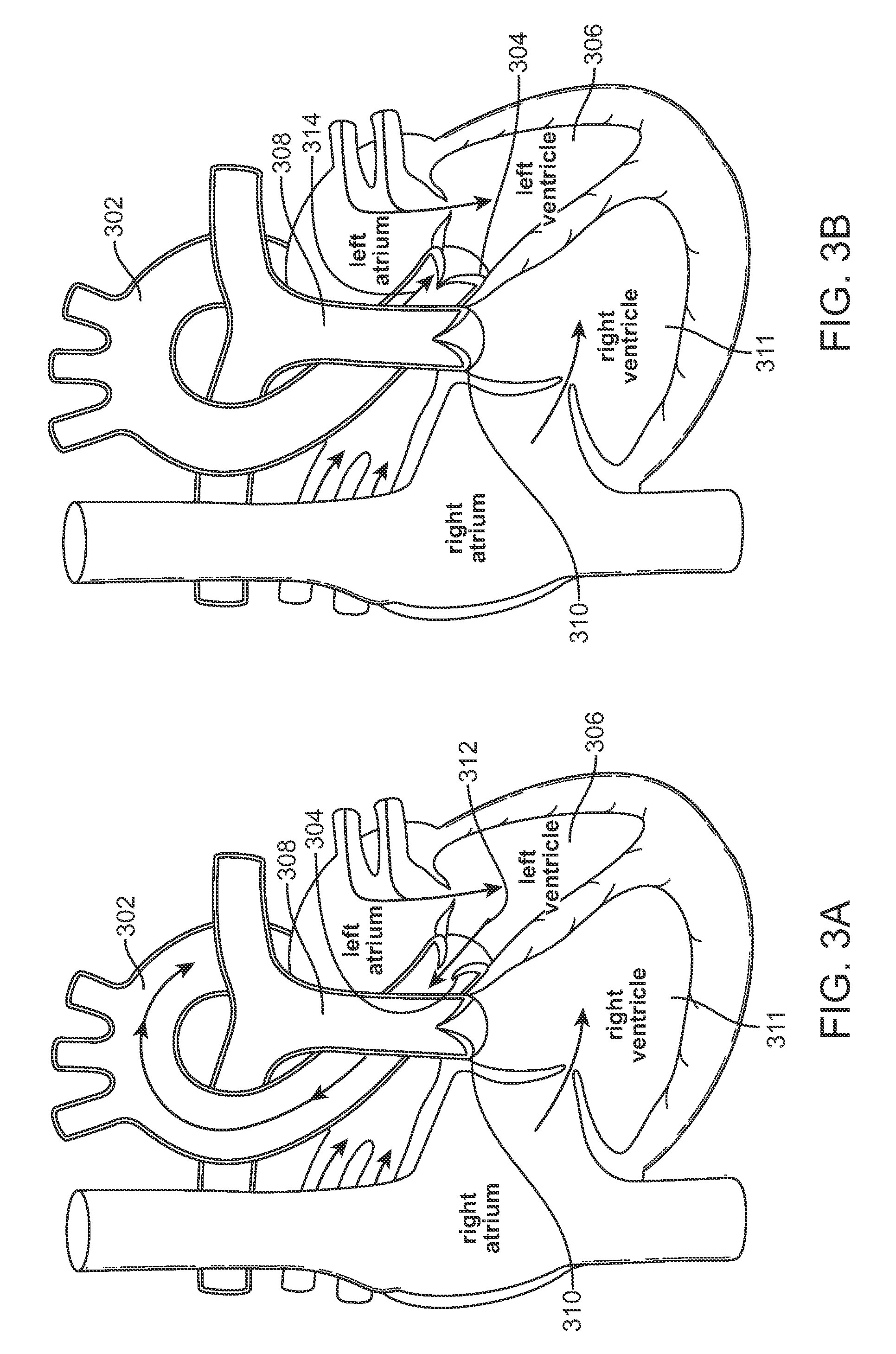 One-way replacement valve