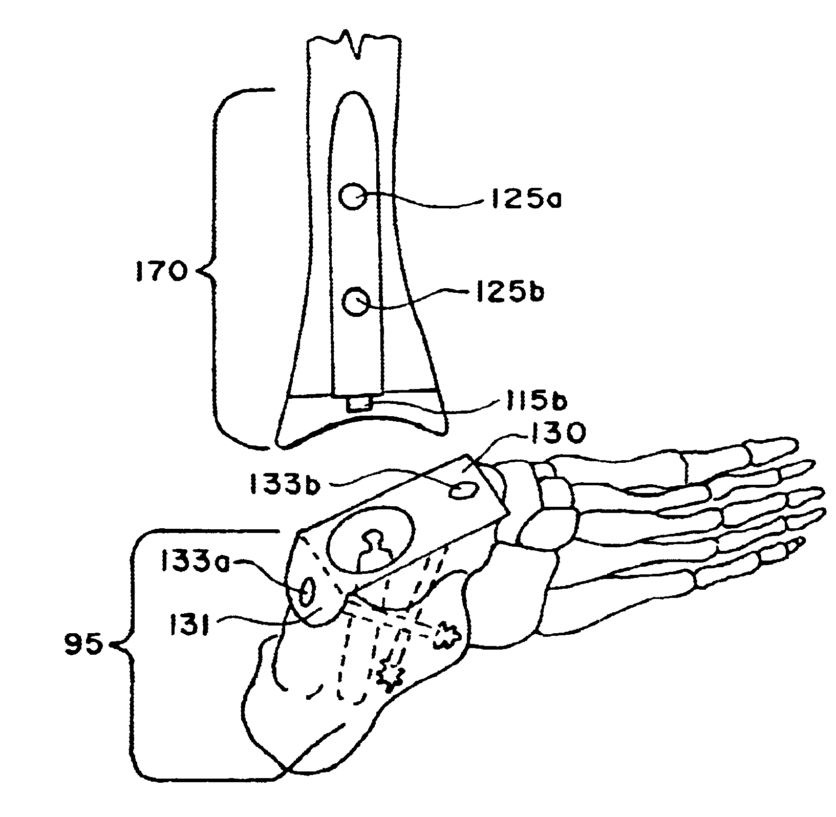 Ankle replacement system