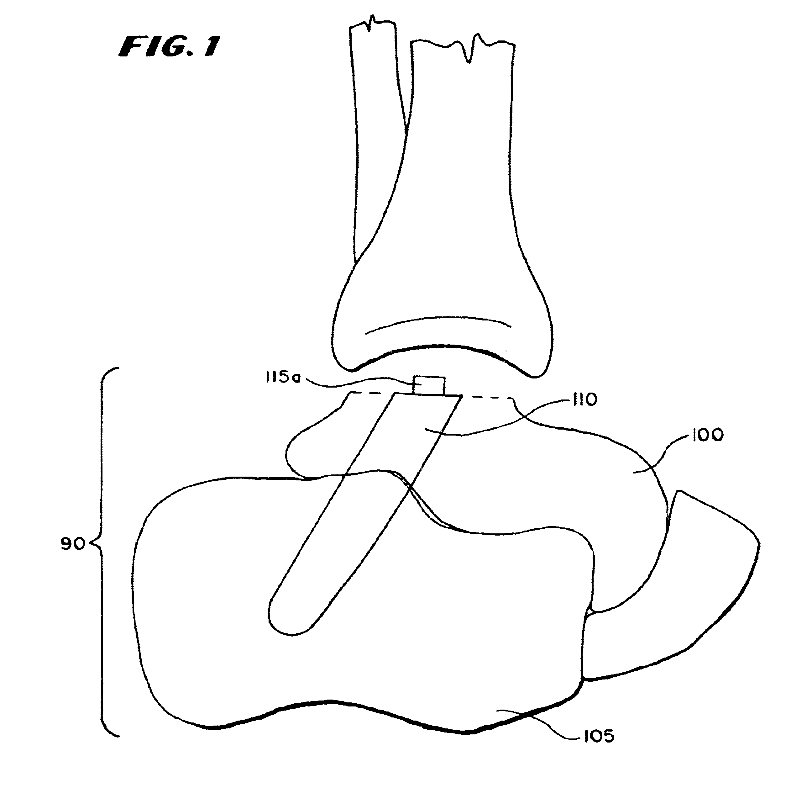 Ankle replacement system