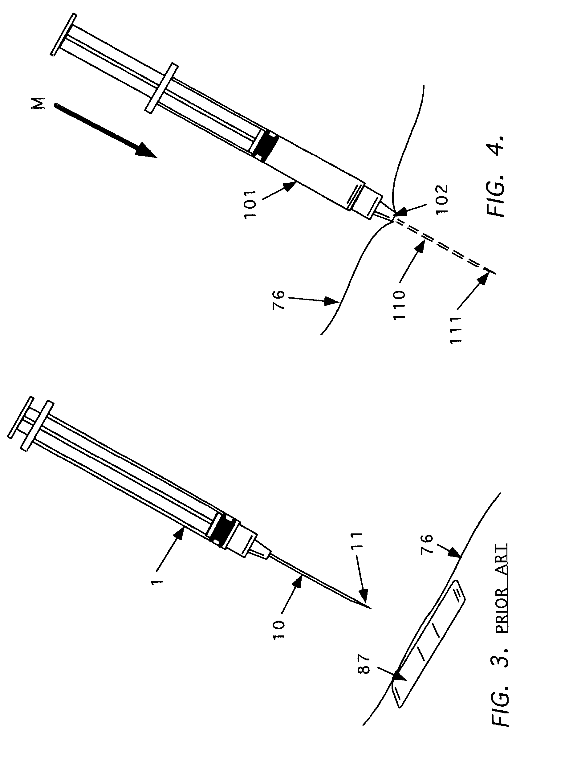 Method and apparatus for indicating or covering a percutaneous puncture site