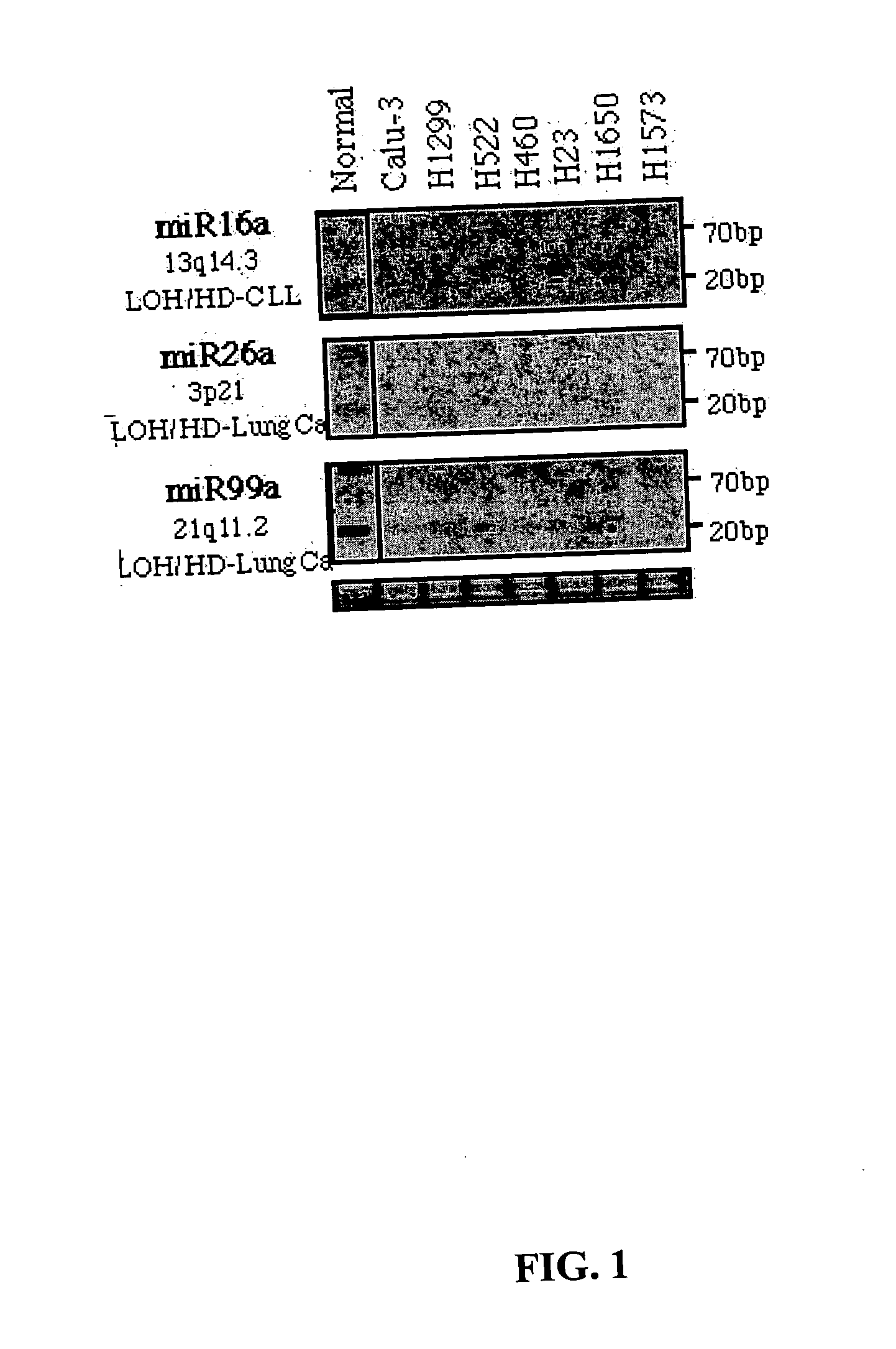 Diagnosis and treatment of cancers with microRNA located in or near cancer associated chromosomal features