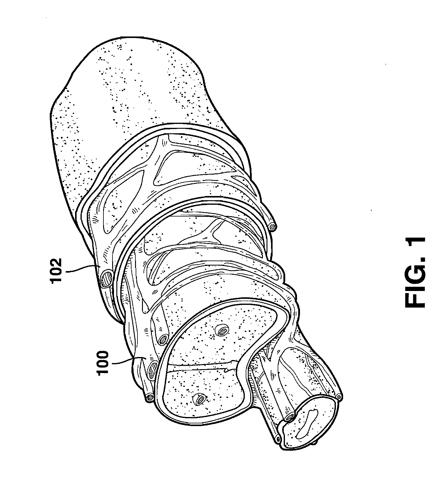 Implantable Venous Valve for Treatment of Erectile Dysfunction