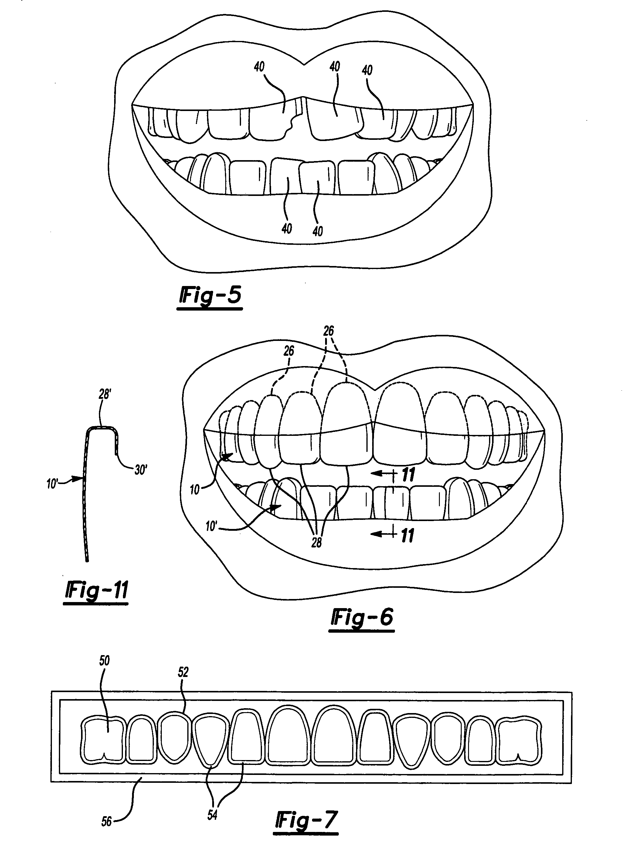 Dental template and method of visually demonstrating an overlay for a dental patient and setting the horizontal plane with an overlay