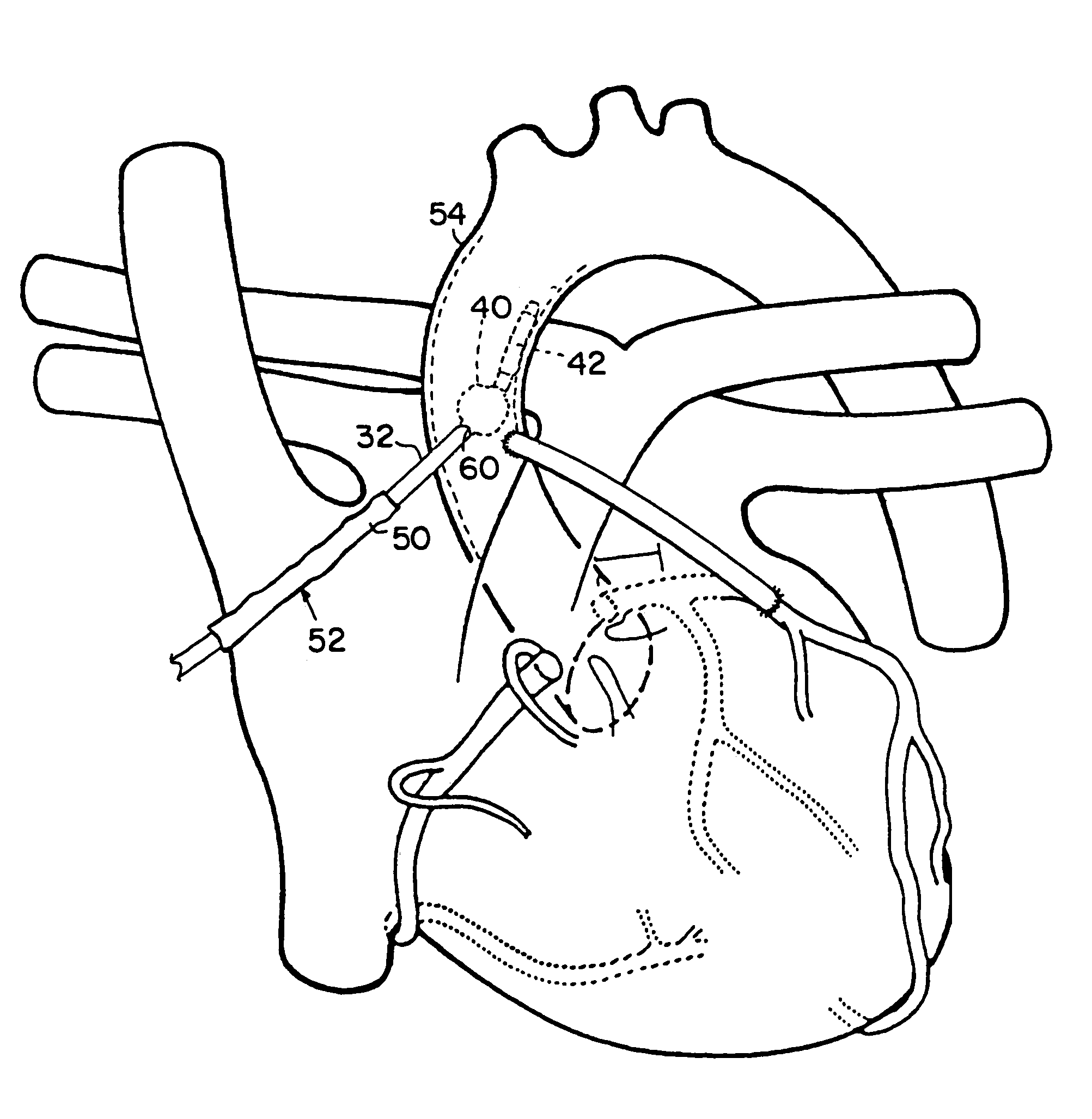 Intravascular balloon occlusion device and method for using the same