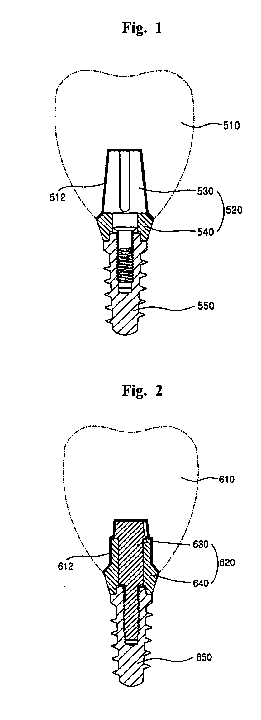 Abutment of dental implant and aesthetic surface treatment method of the same