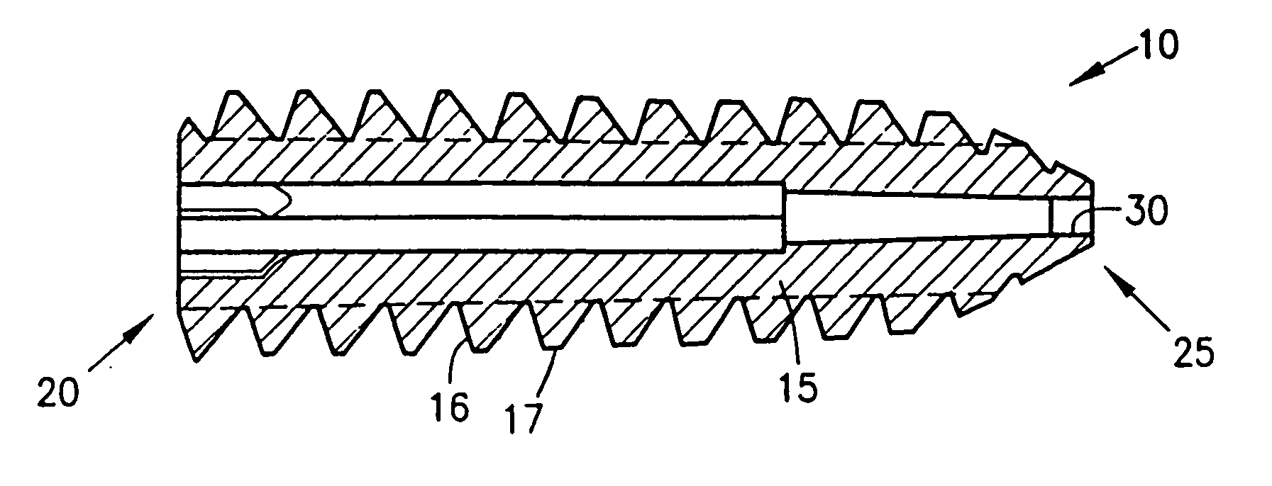 Tapered bioabsorbable interference screw for endosteal fixation of ligaments