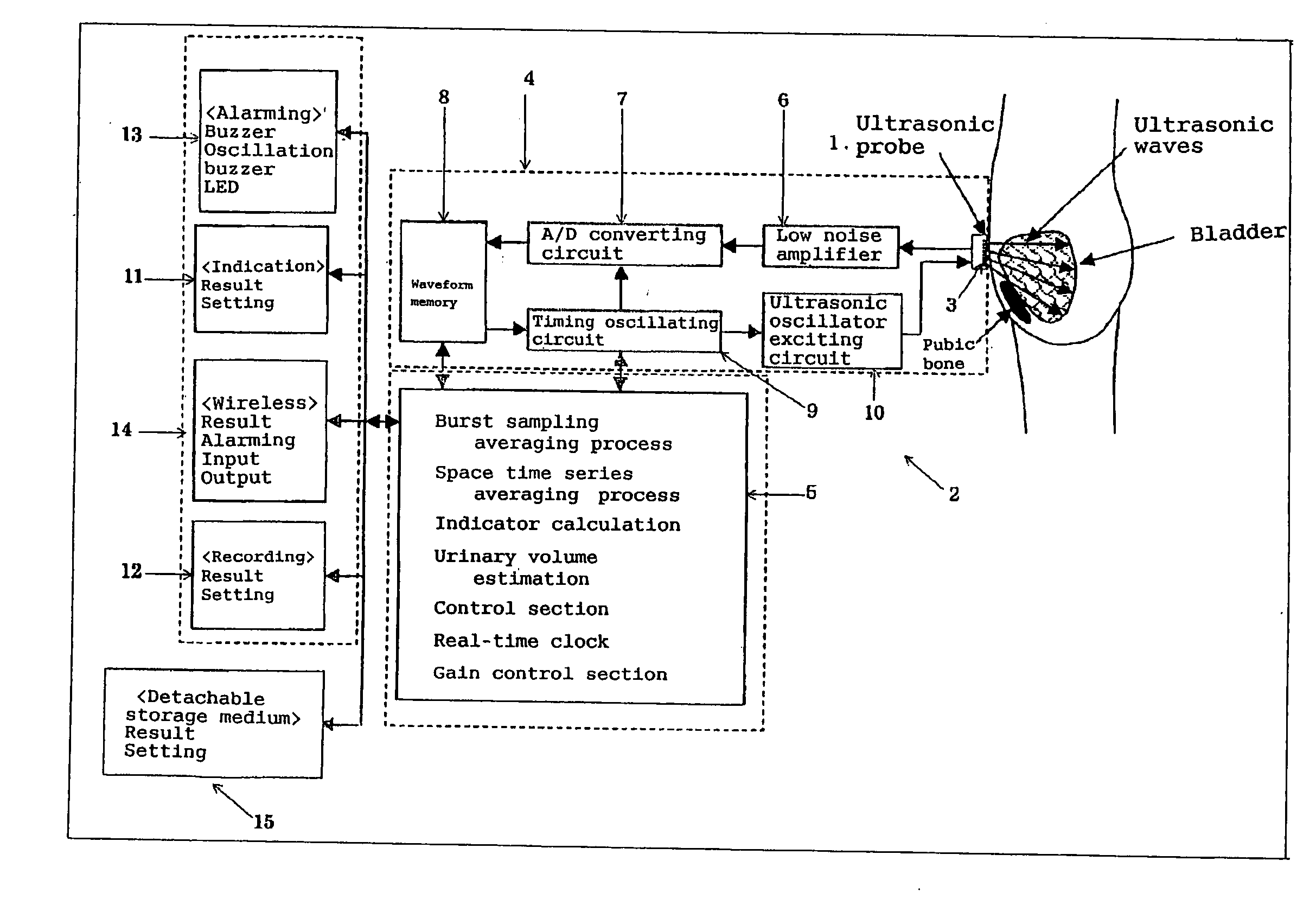 Ultrasonic Urinary Volume Sensor