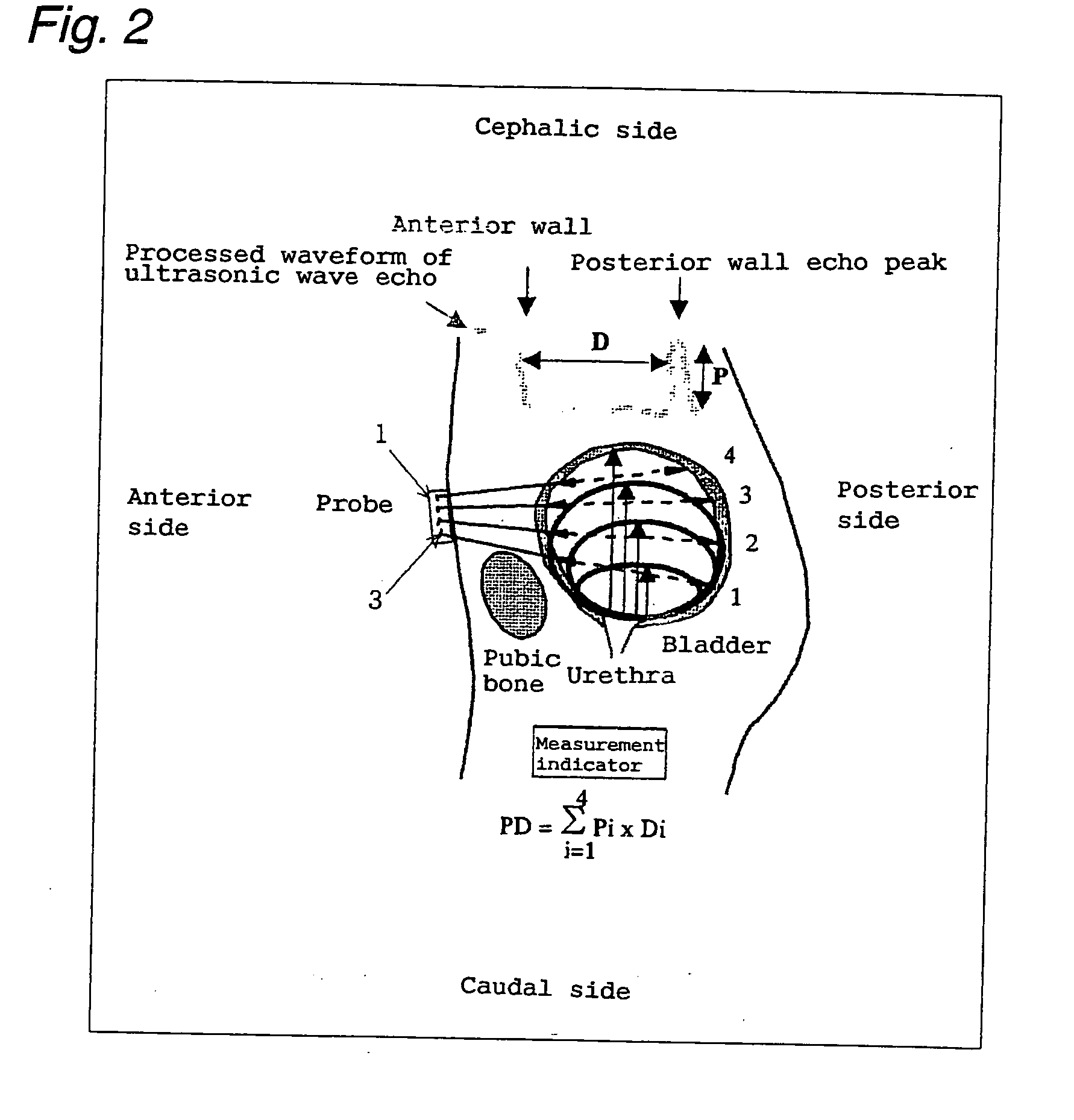 Ultrasonic Urinary Volume Sensor