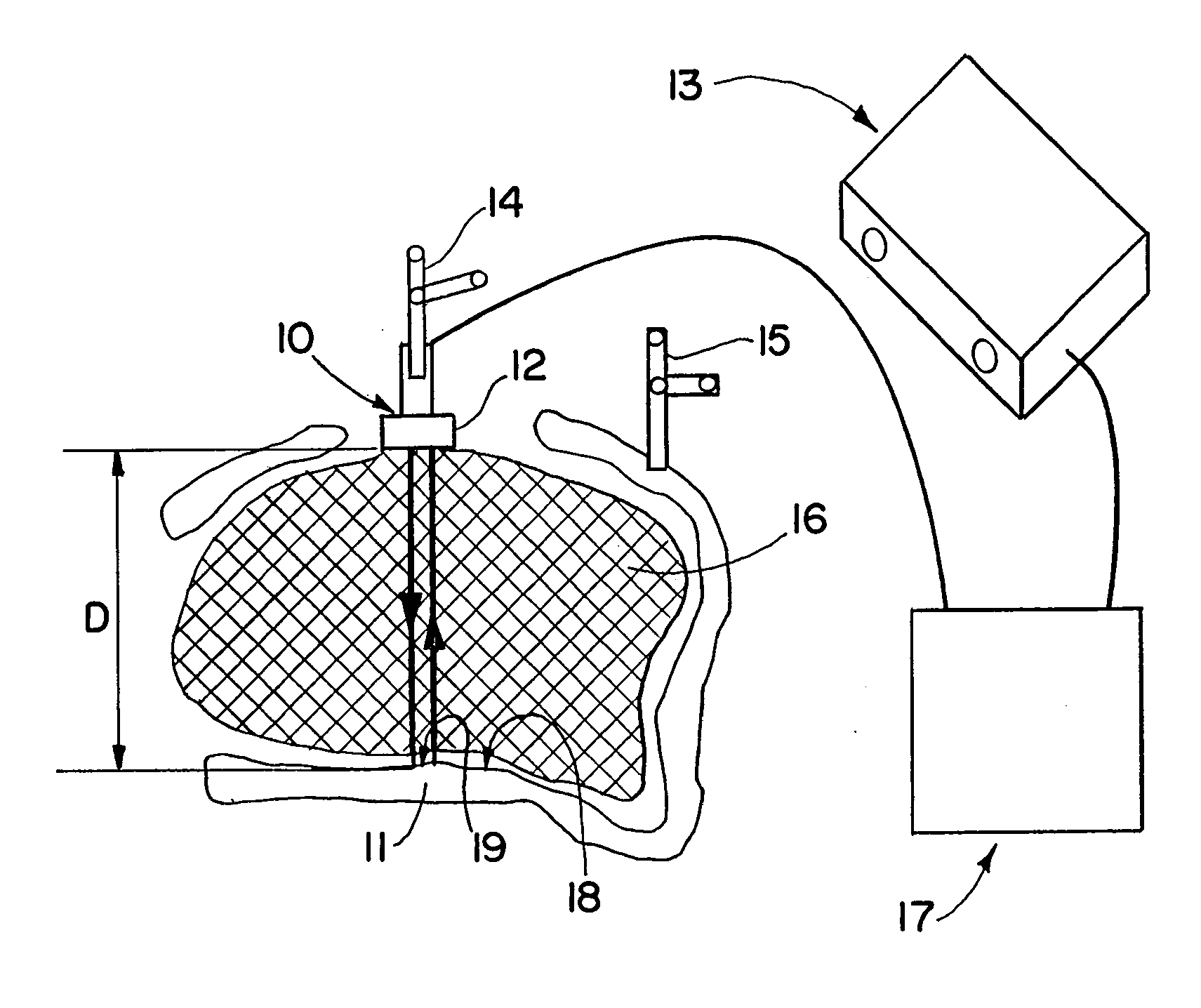 Determination of sound propagation speed in navigated surgeries