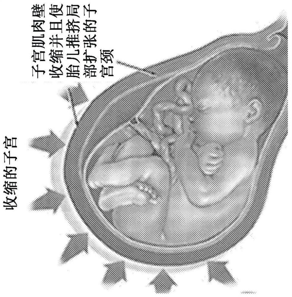 Systems and methods for maternal uterine activity detection