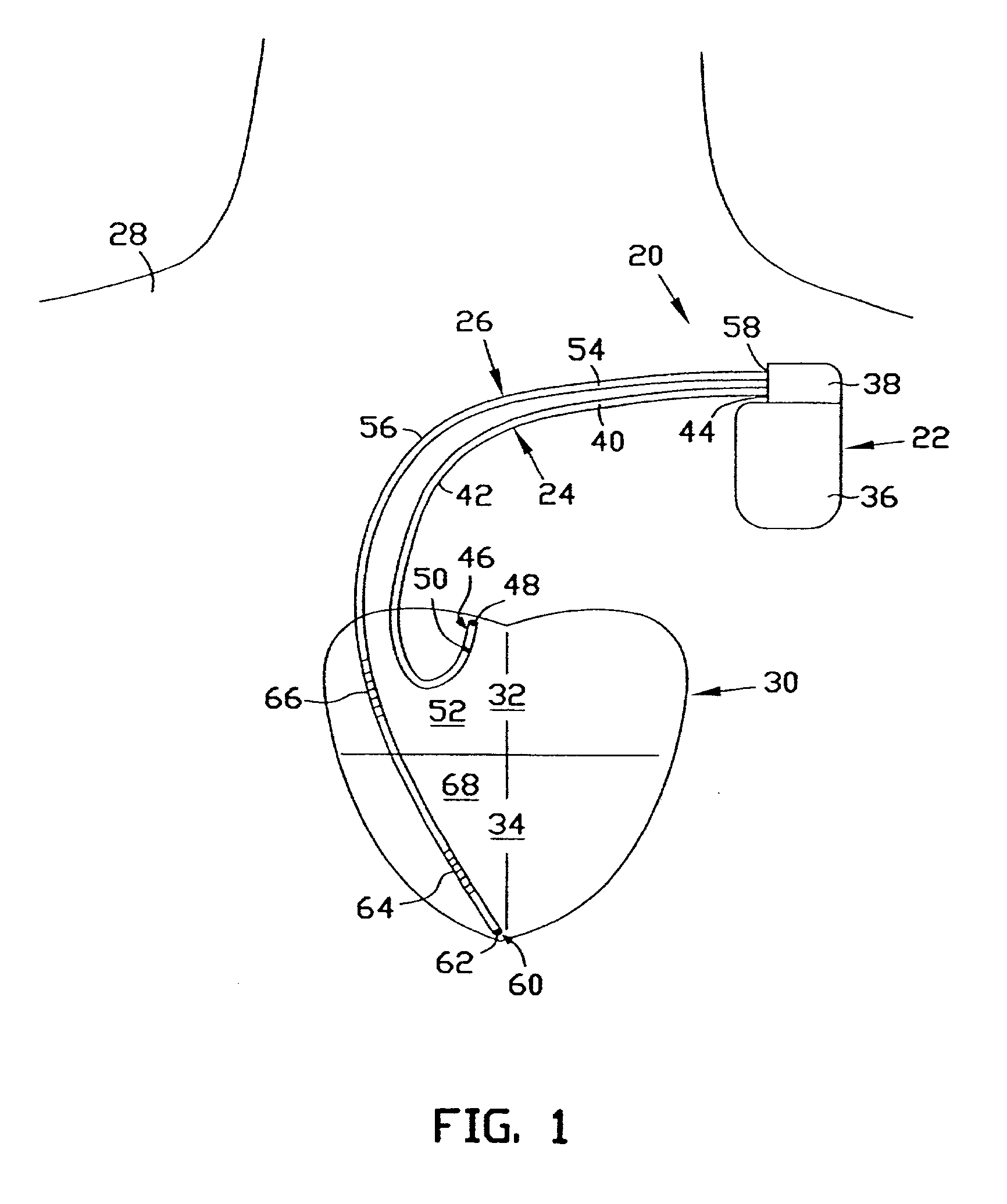 Apparatus and method for treating ventricular tachyarrhythmias