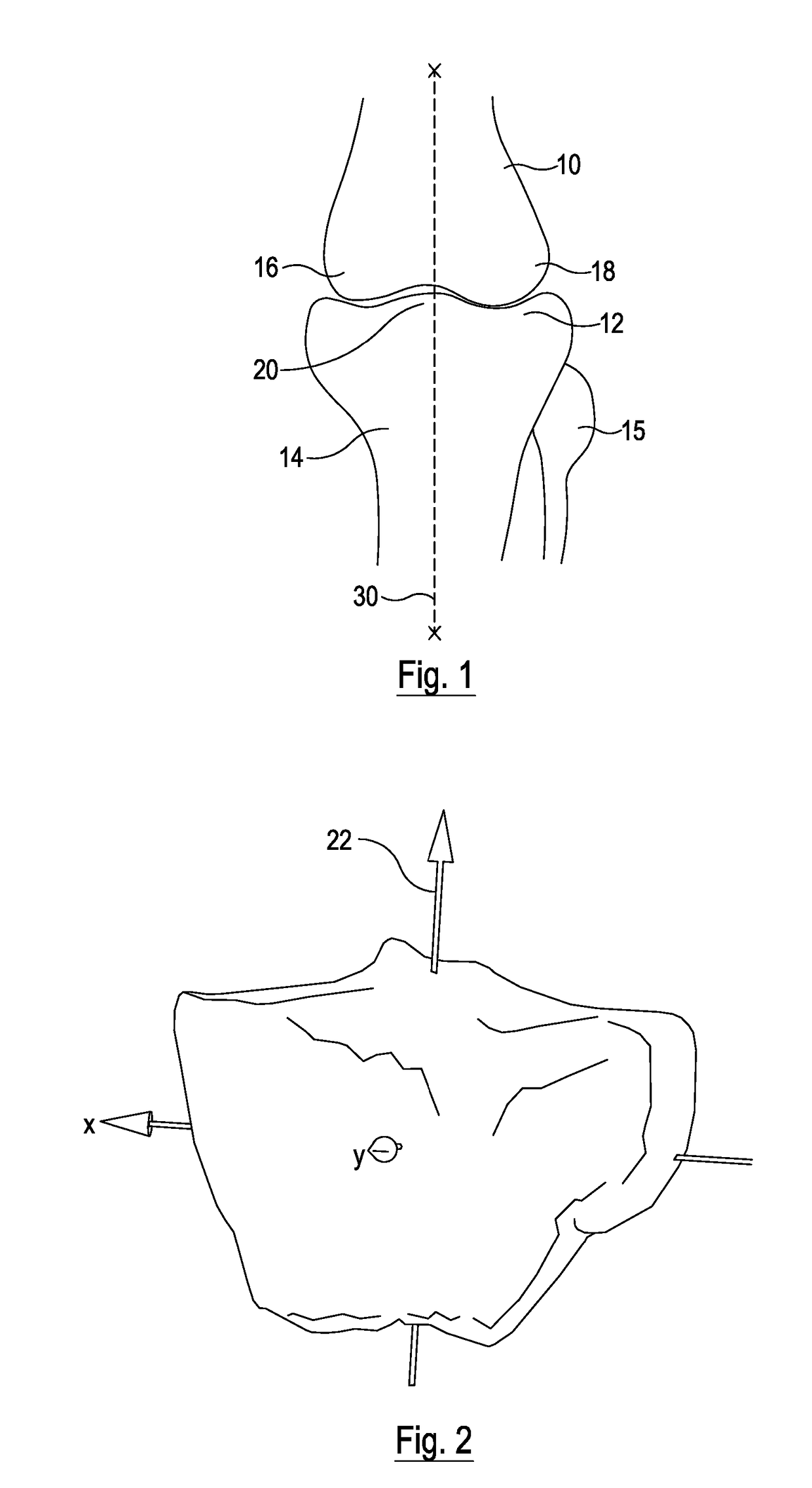 Proximal Tibial Osteotomy System