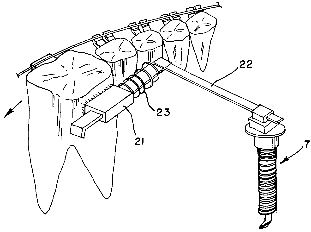 Impacted tooth appliance