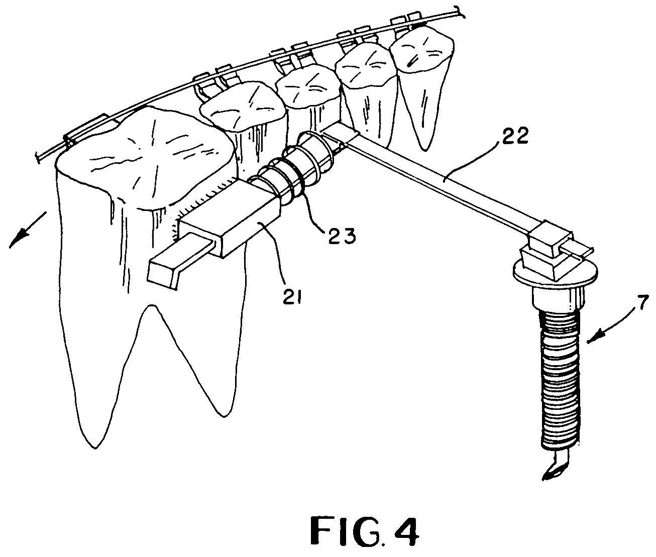 Impacted tooth appliance