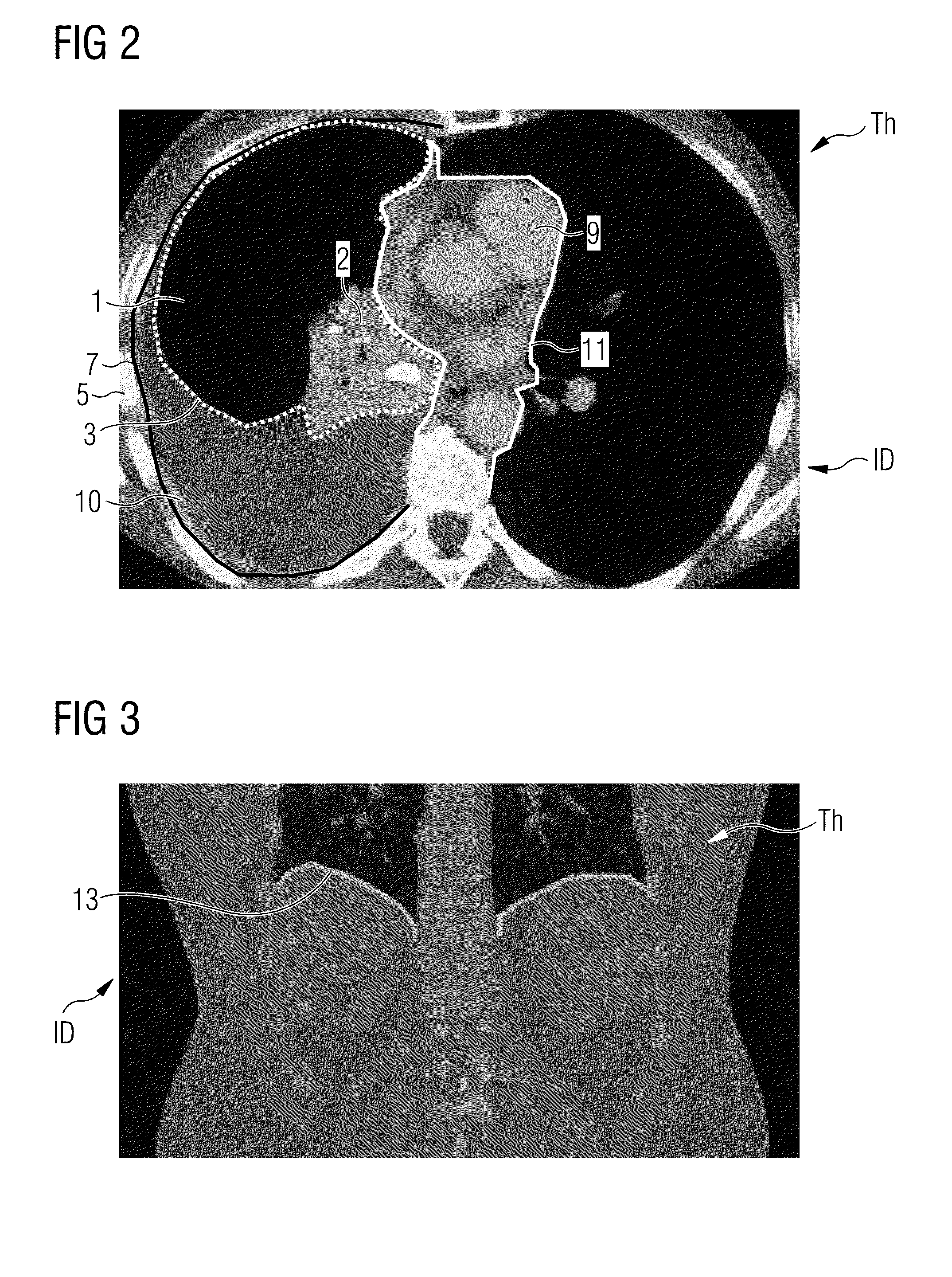 Automatic identification of a potential pleural effusion