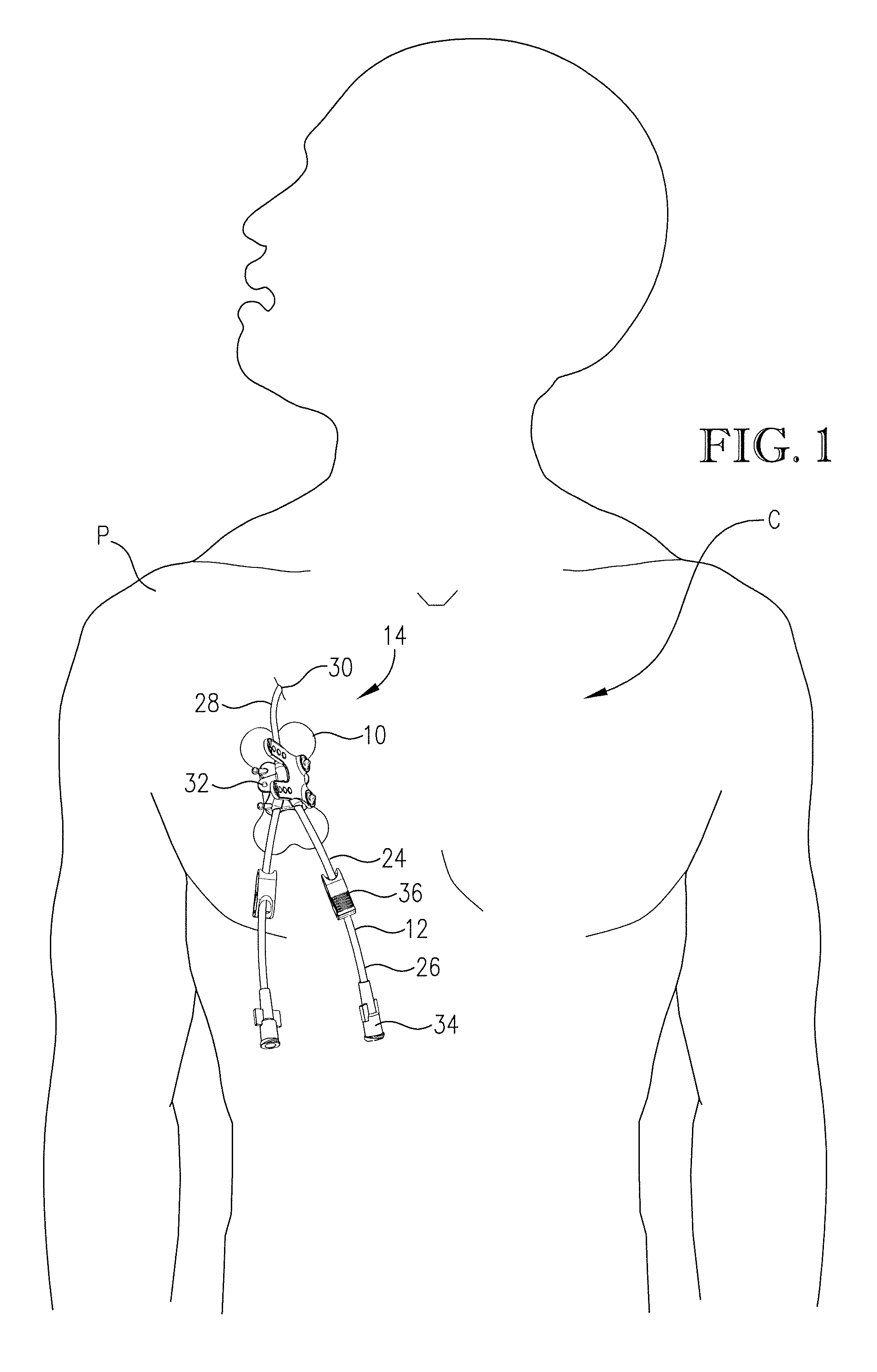 Intravenous catheter anchoring device