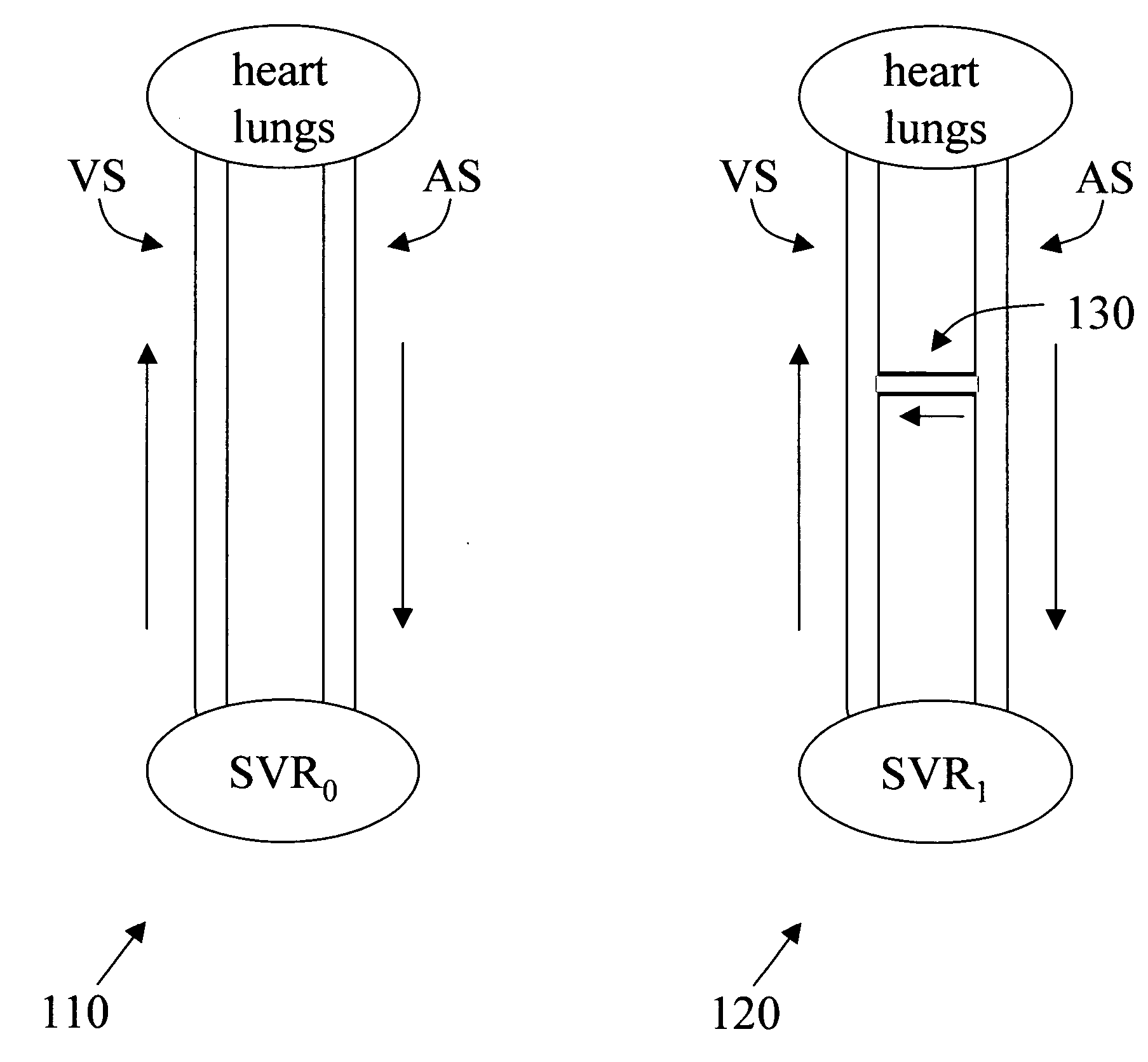 Implantable arterio-venous shunt devices and methods for their use