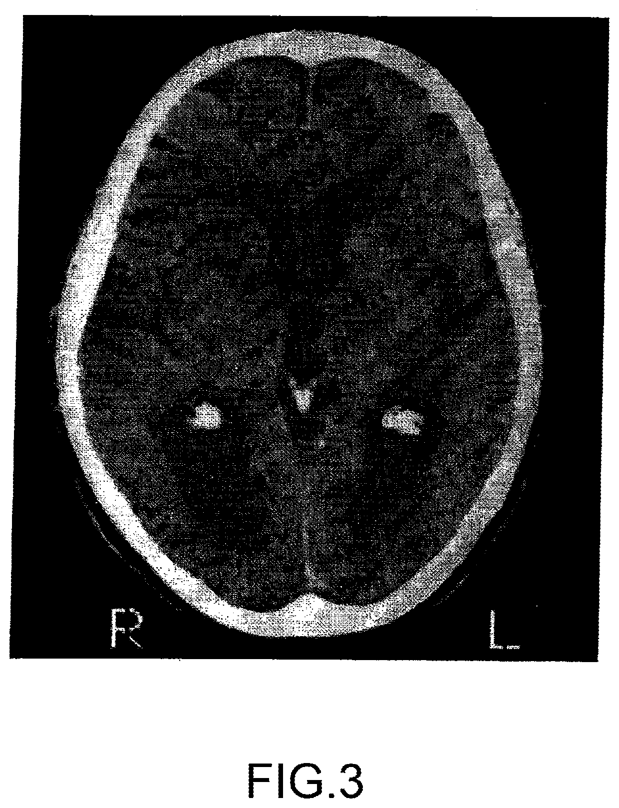 Method and System for Reducing the Likelihood of a Porphyromonas Gingivalis Infection in a Human Being