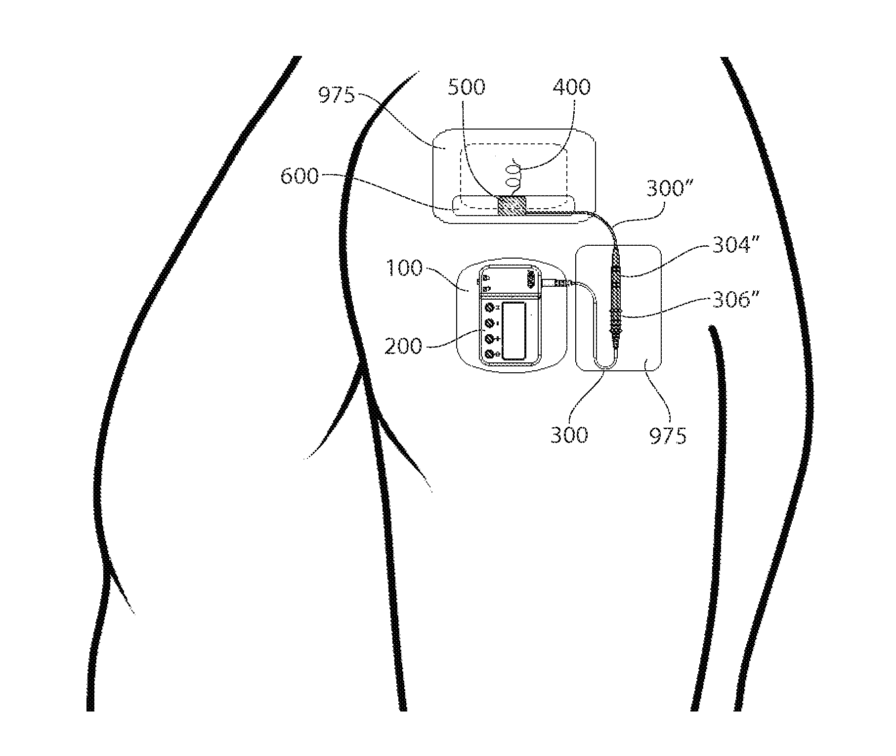 Systems and methods for percutaneous electrical stimulation