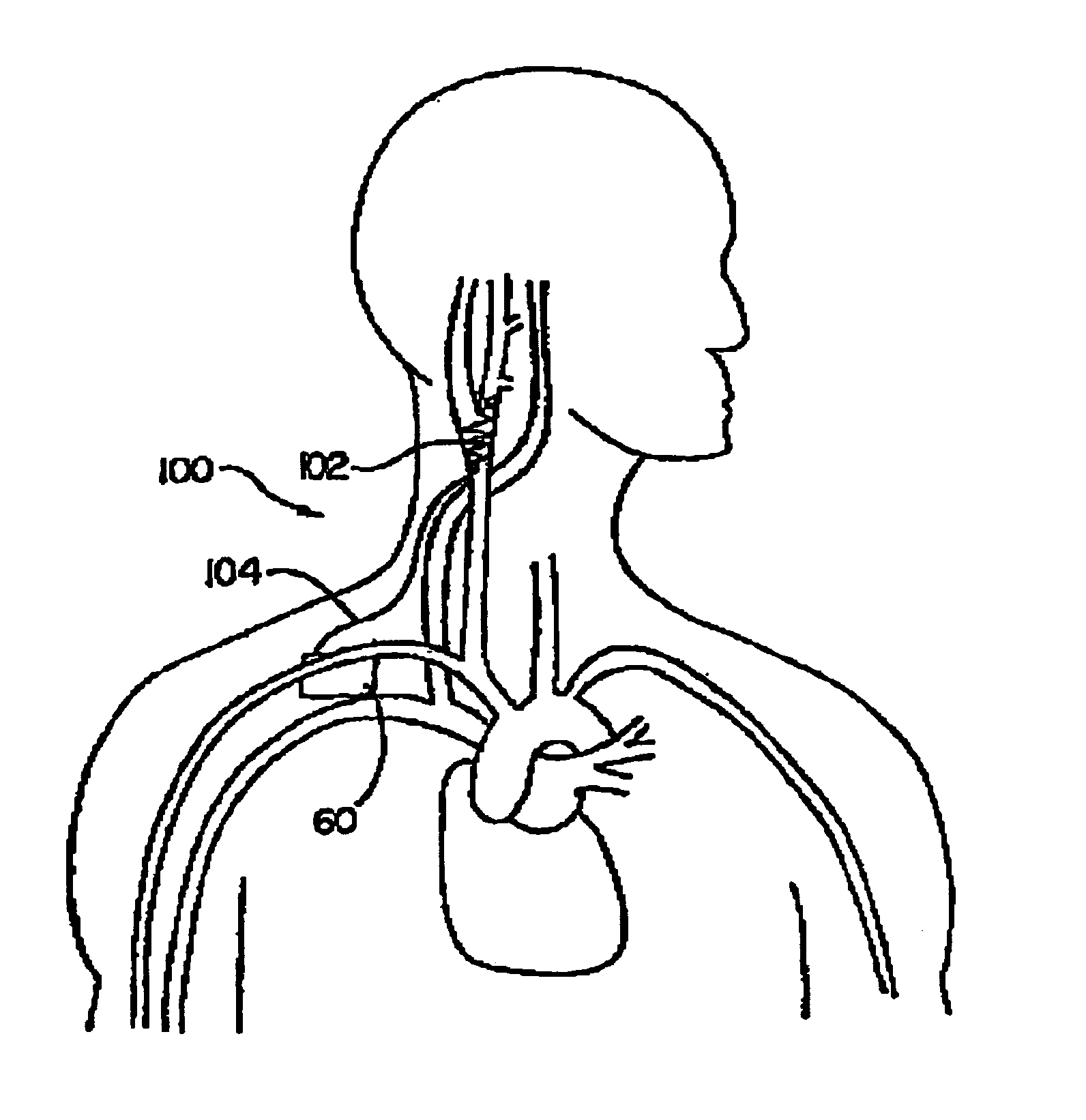 Mapping methods for cardiovascular reflex control devices