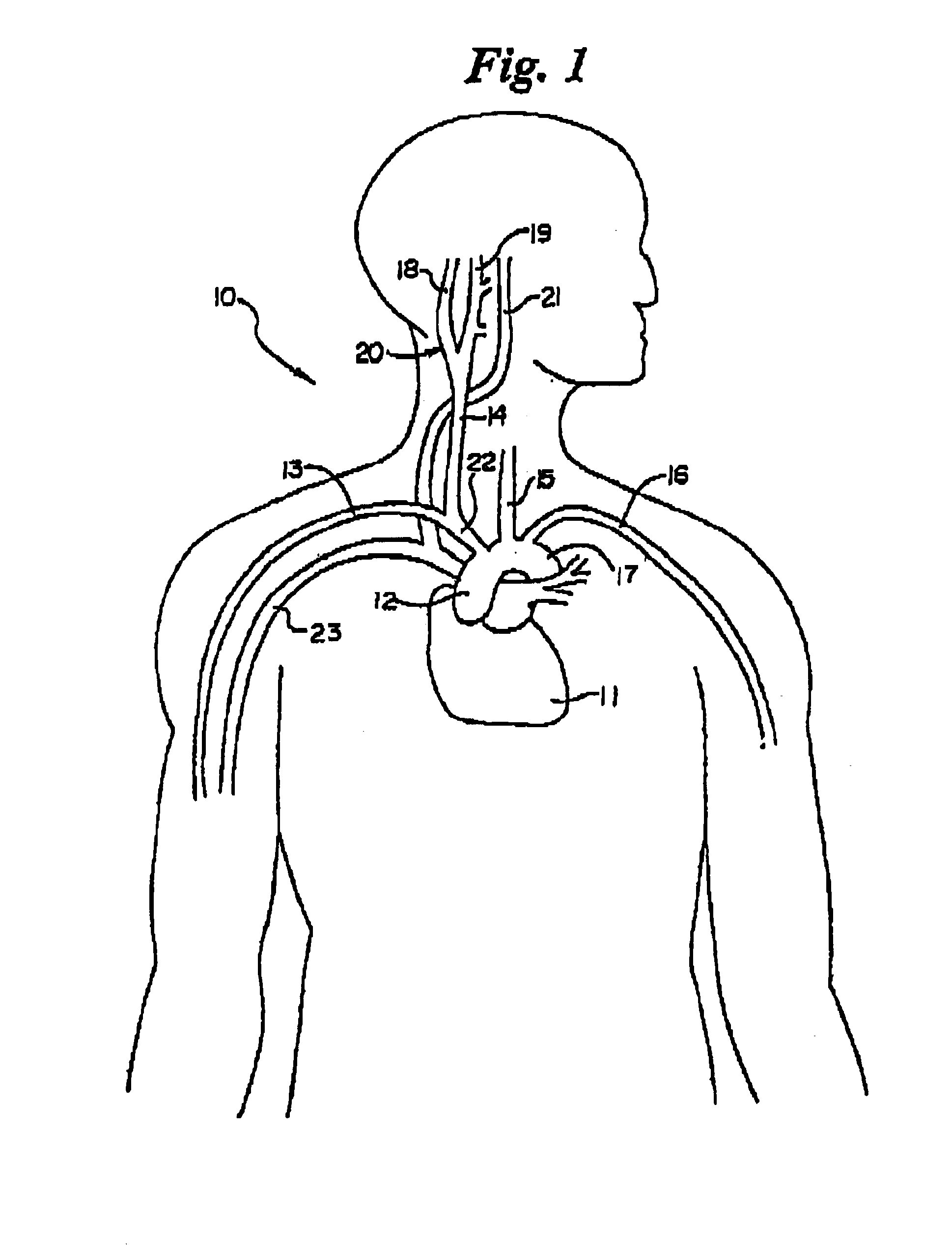 Mapping methods for cardiovascular reflex control devices