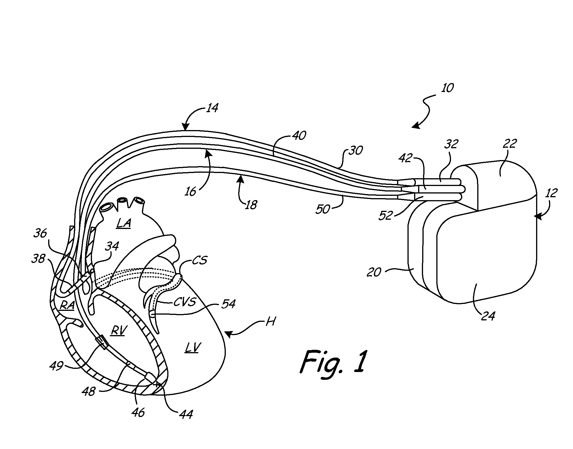 Implantable Medical Device with Electromechanical Delay Measurement for Lead Position and Ventricular