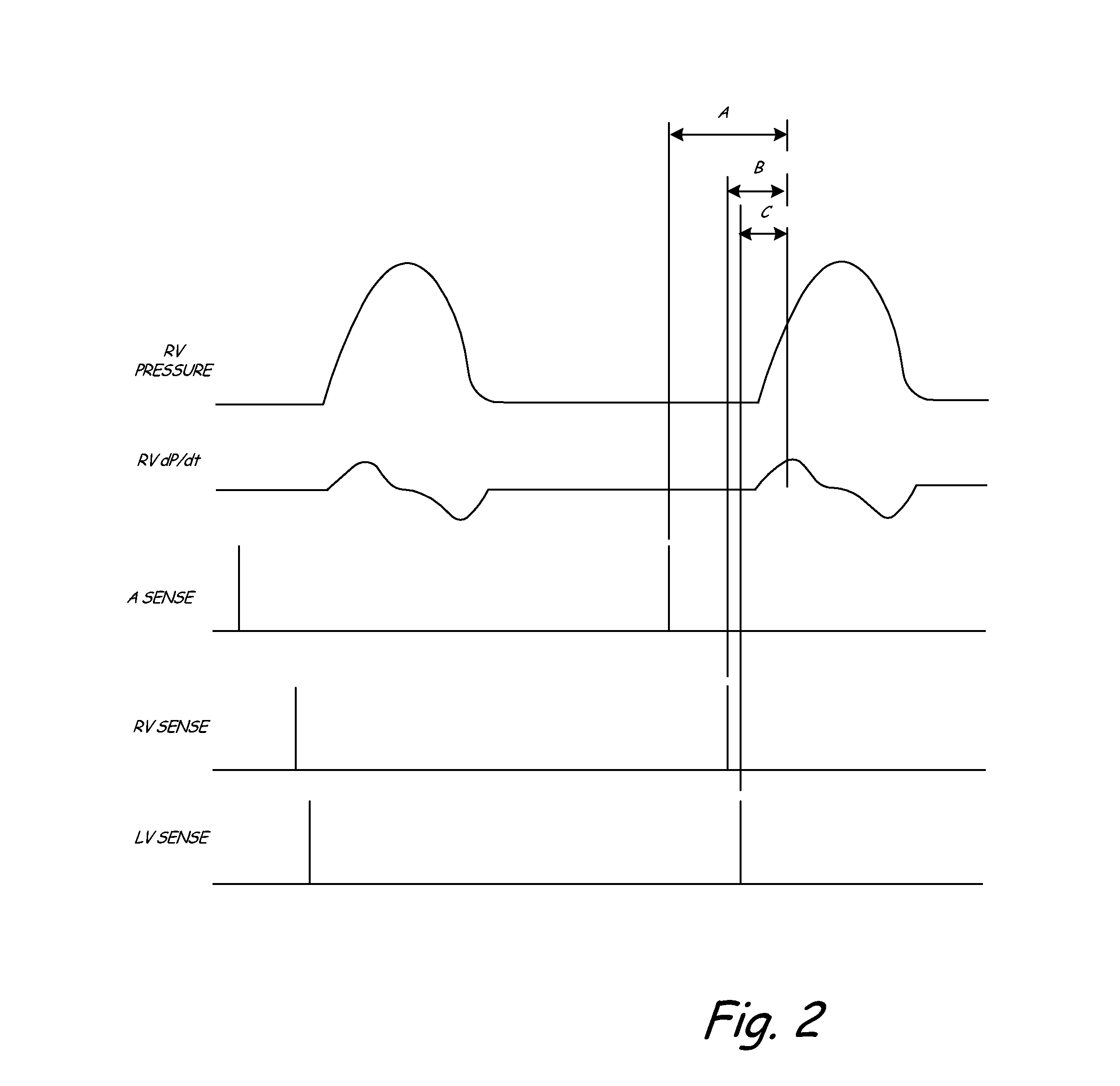 Implantable Medical Device with Electromechanical Delay Measurement for Lead Position and Ventricular