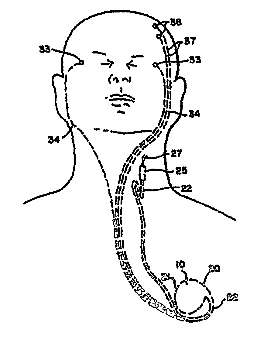 Cervical wagal stimulation induced weight loss