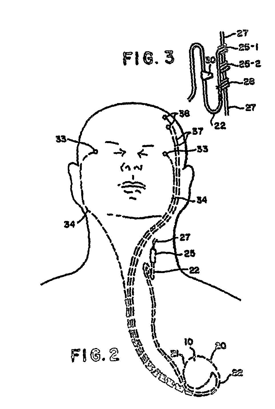 Cervical wagal stimulation induced weight loss