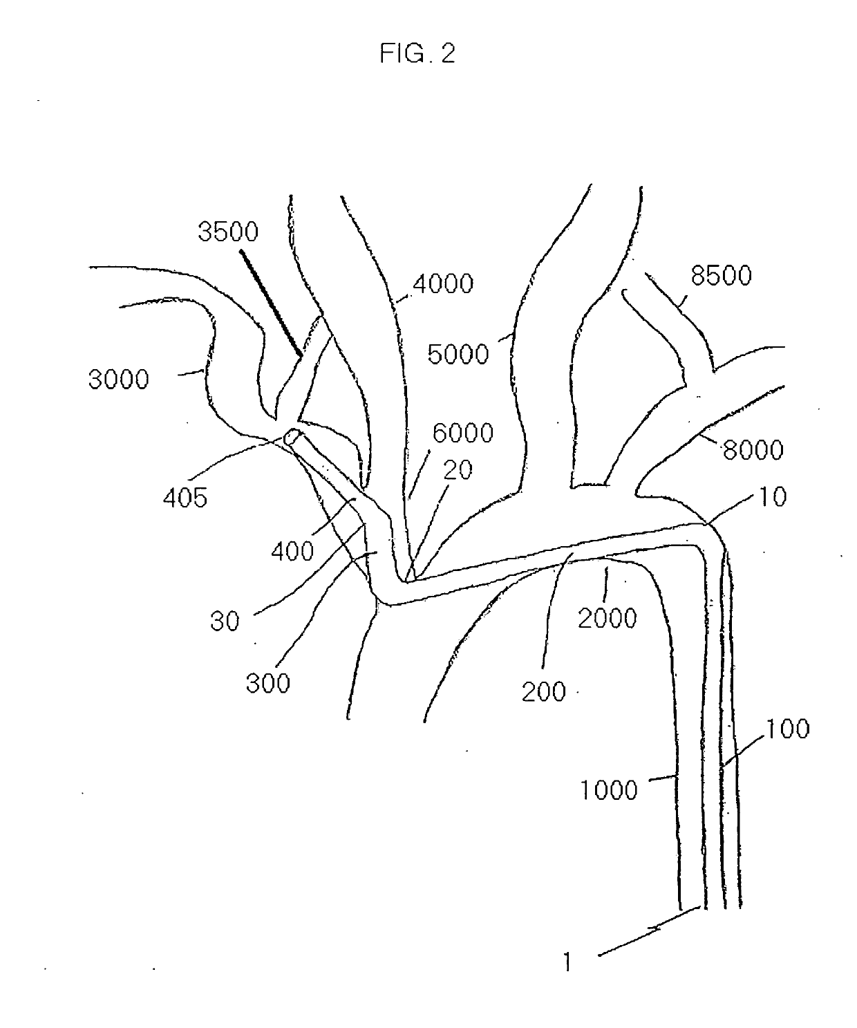 Arm access arch fulcrum support catheter