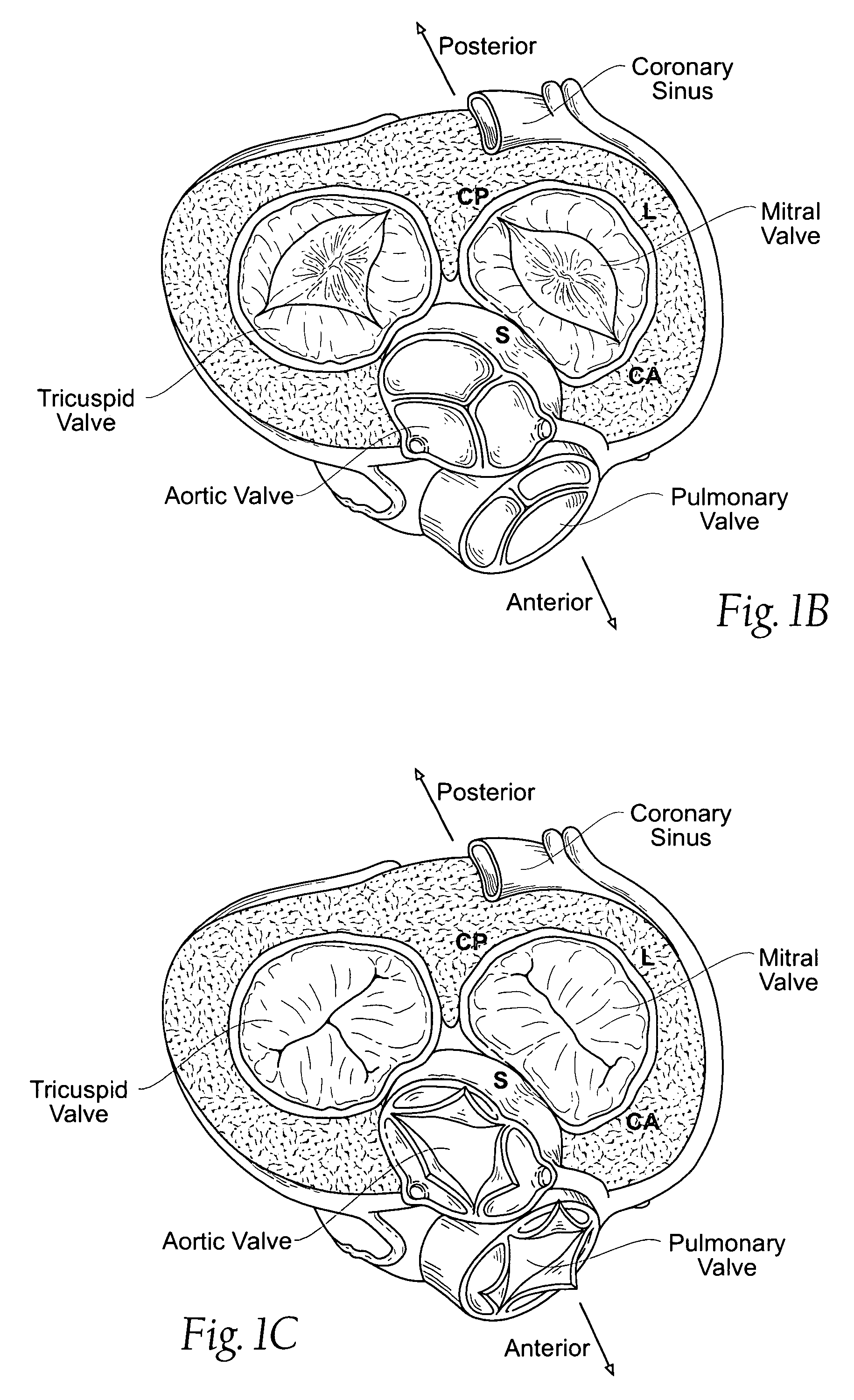 Devices, systems, and methods for retaining a native heart valve leaflet