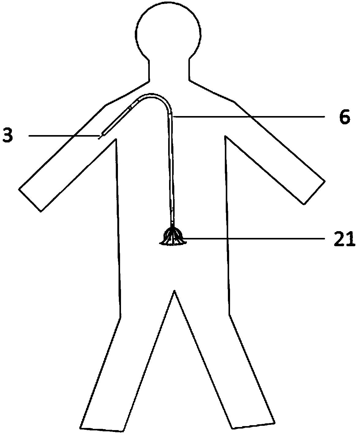 Inferior vena cava temporary filter