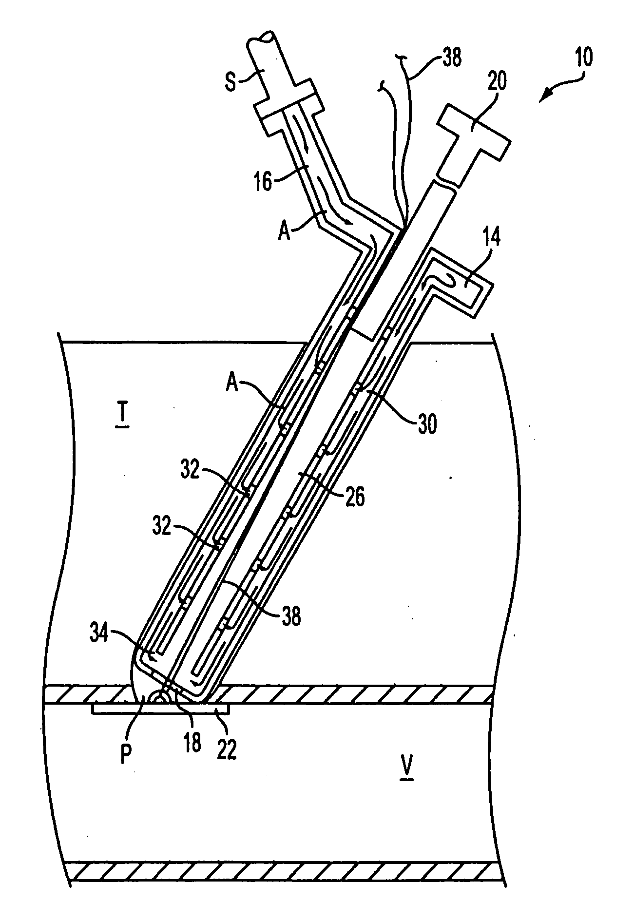 Autologous wound sealing apparatus