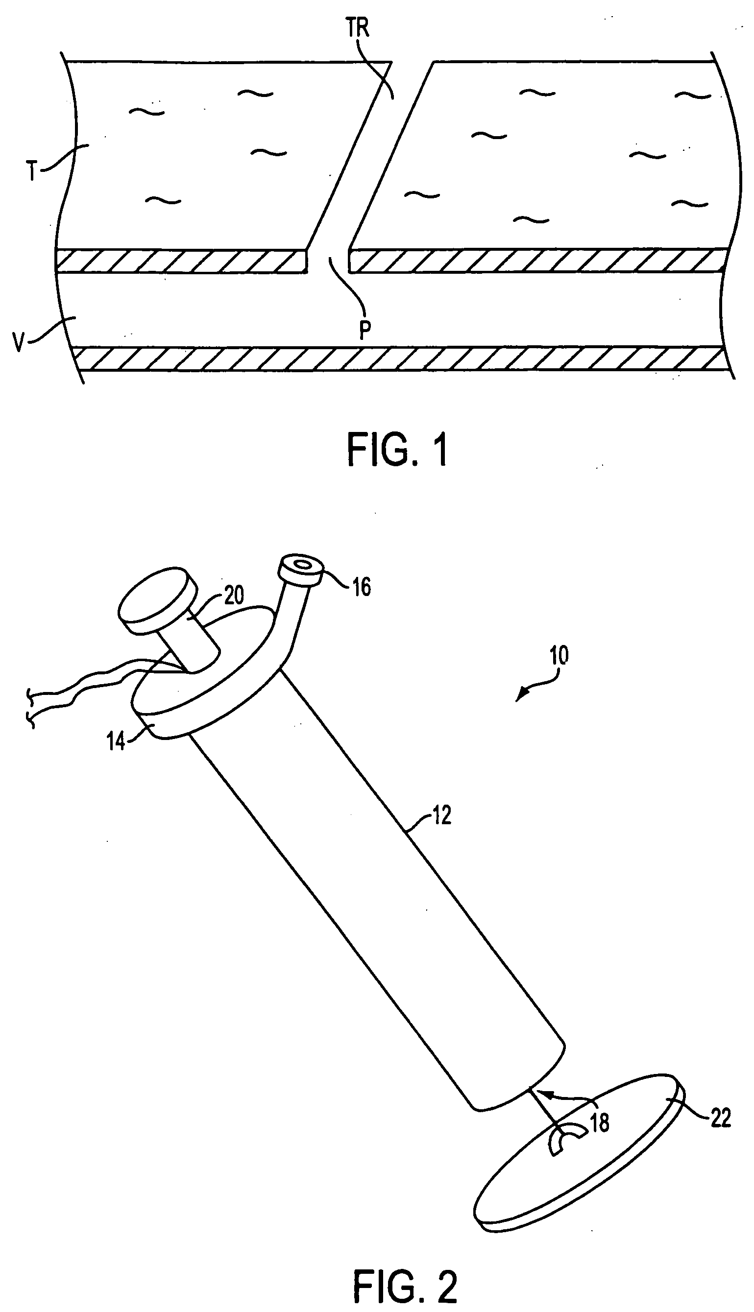 Autologous wound sealing apparatus