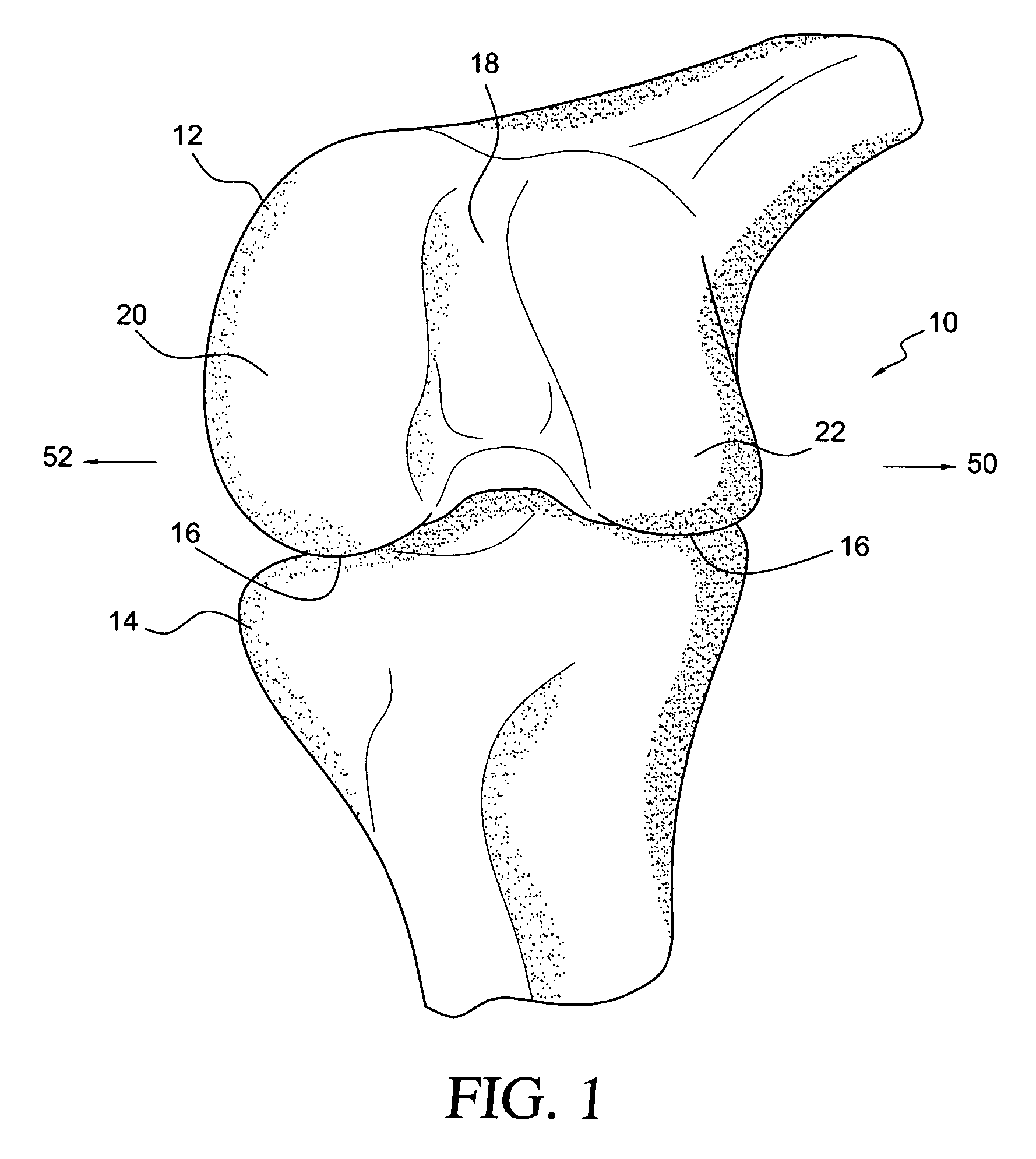 Osteochondral plug graft harvesting instrument and kit