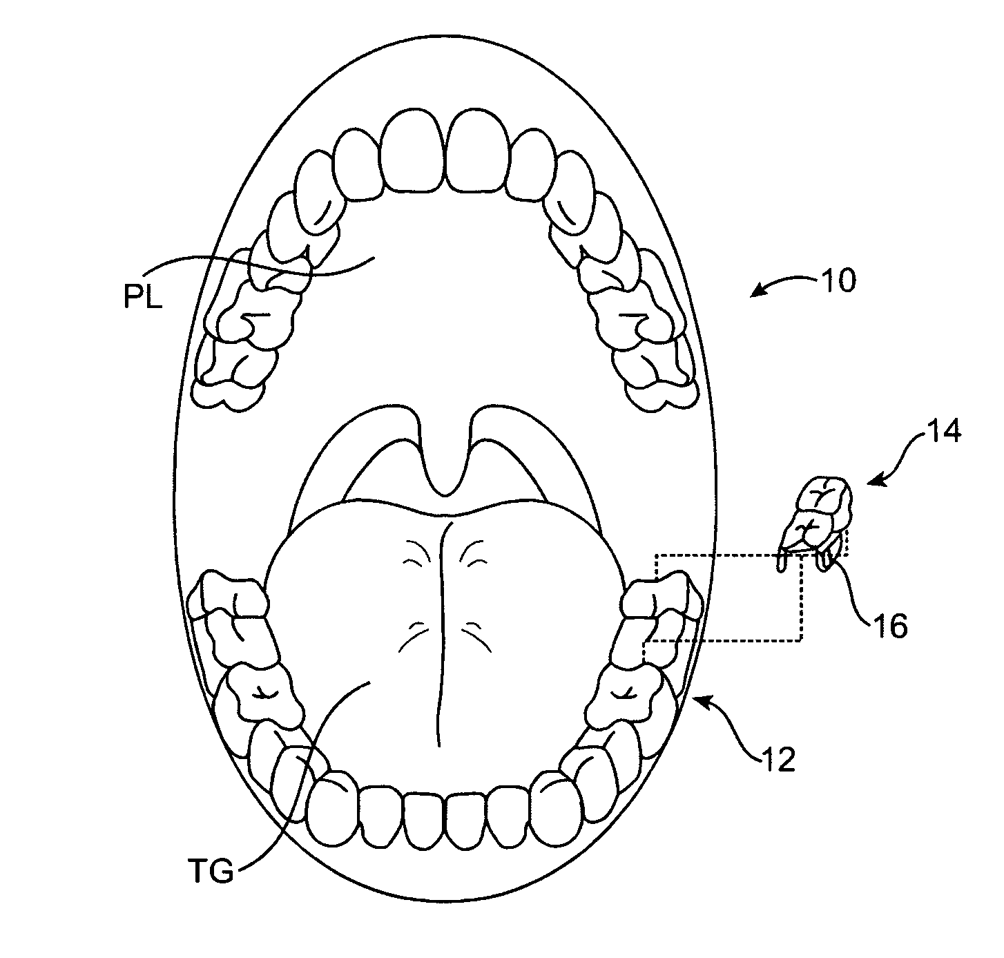 Tinnitus masking systems